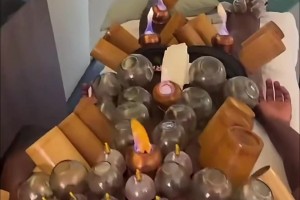 满背都是火罐！奥纳纳晒密集拔罐视频，网友：直接变刺猬了！